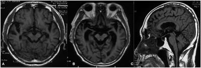 An atypical ALS with PSP-like symptoms caused by ANXA11 p.D40G mutation: A case report and literature review